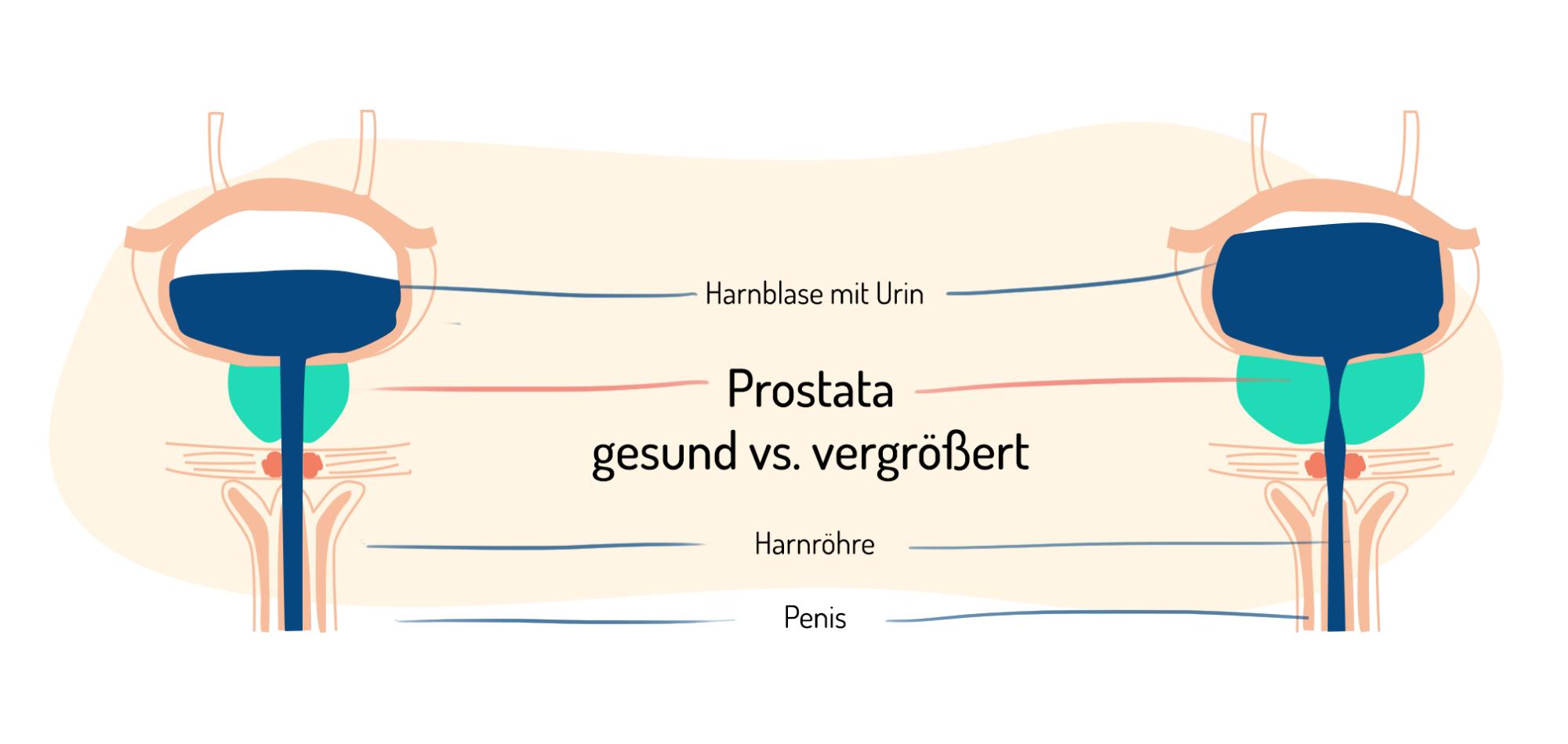 Prostatavergrößerung Die Checkliste für Harninkontinenz